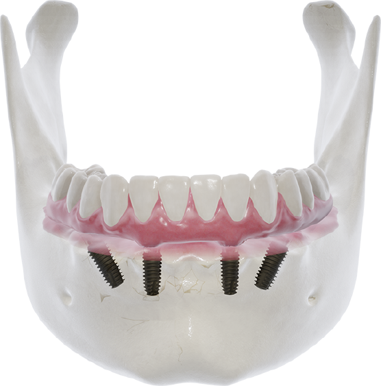 دست دندان کامل با دندانپزشکی دیجیتال